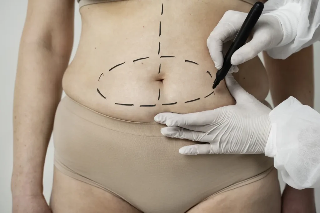 Máster en Abdominoplastia y Cirugía Postbariátrica 1
