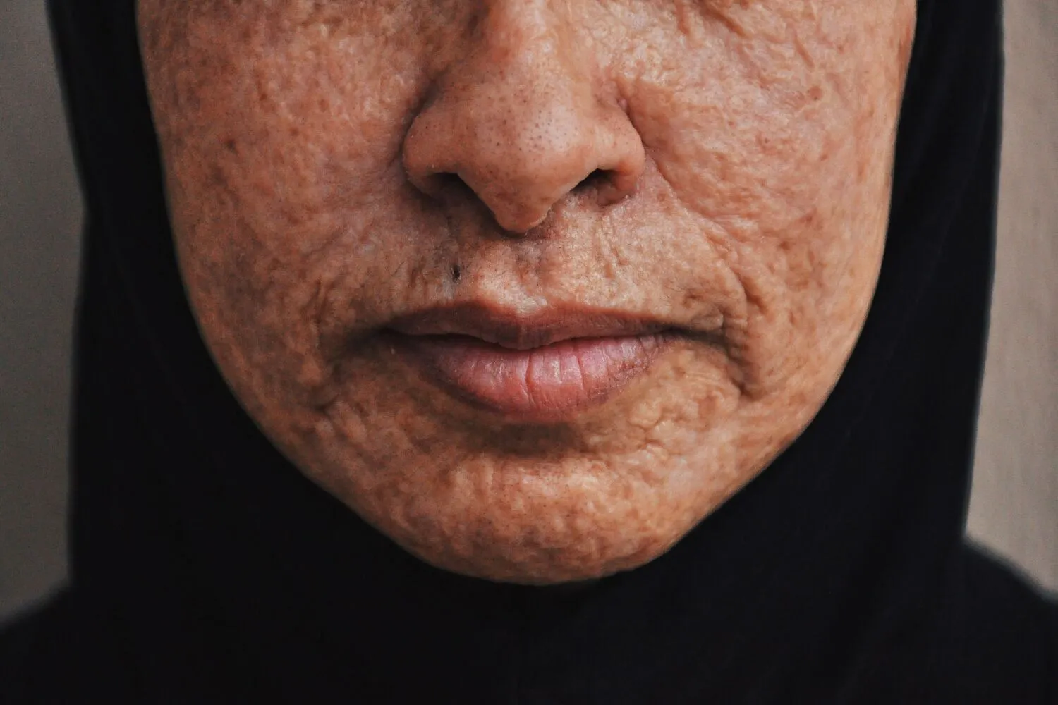 Máster en Cosmética para Hiperpigmentación y Melasma 2