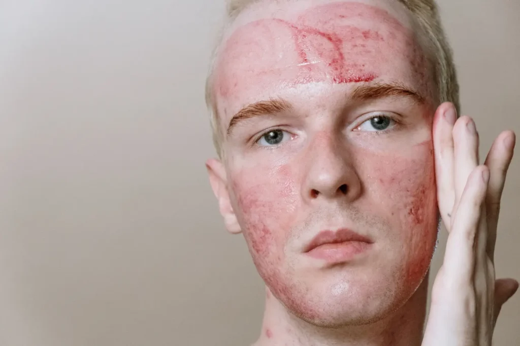 Máster en Dermatitis Atópica y de Contacto y su Impacto Estético 1