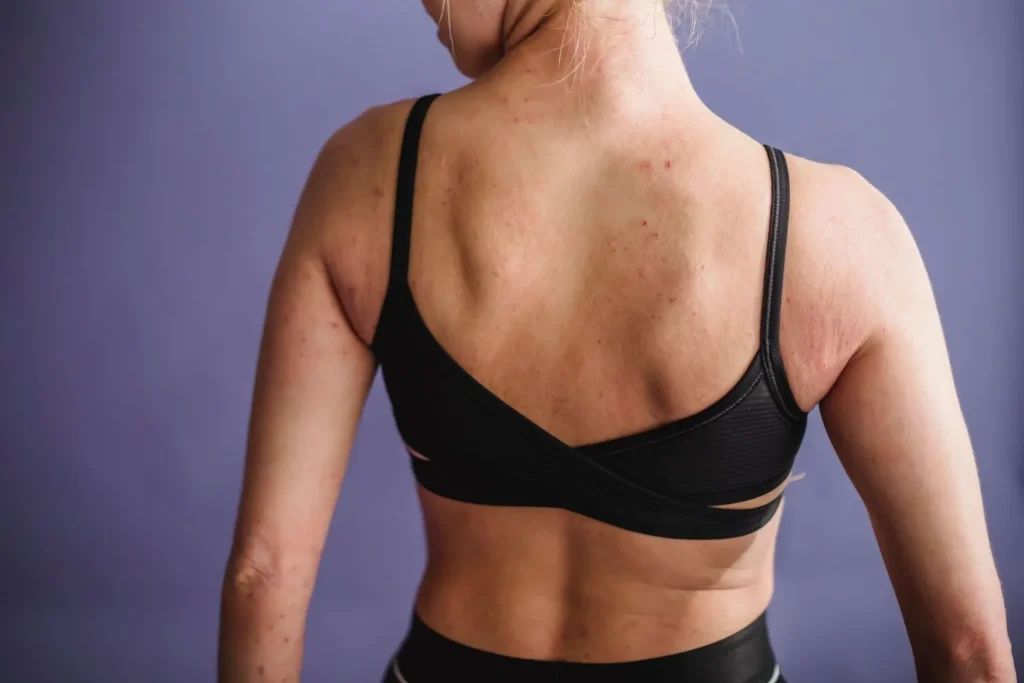 Máster en Dermatitis Atópica y de Contacto y su Impacto Estético 3