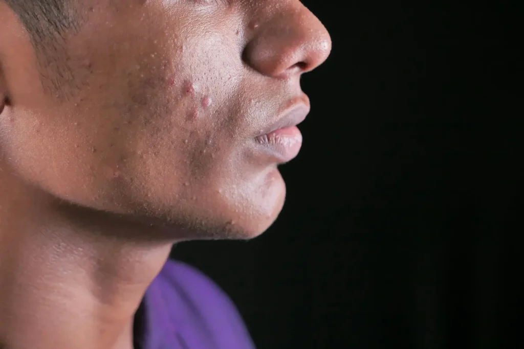 Máster en Cosmética para Patologías Acné Rosácea y Dermatitis Máster en Cosmética para Patologías Acné Rosácea y Dermatitis 1
