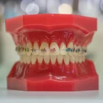 Curso en Diseño Digital de Prótesis Dentales 1