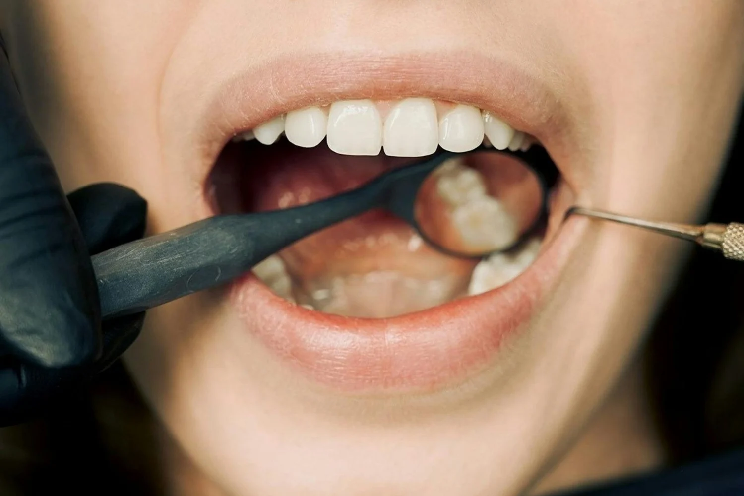 ISEE, CURSOS ONLINE- Diplomado en Técnicas Avanzadas de Blanqueamiento Dental