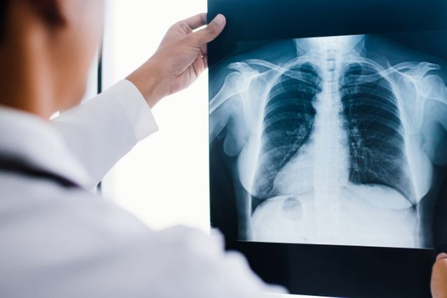 ISEIE-Máster en Oncología Torácica