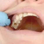 ISEIE-Máster en Odontología Restauradora