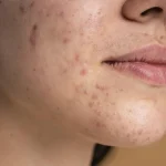 Máster en Acné Protocolos Clínicos Cicatrices y Abordaje Combinado 1