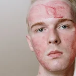 Máster en Dermatitis Atópica y de Contacto y su Impacto Estético 1